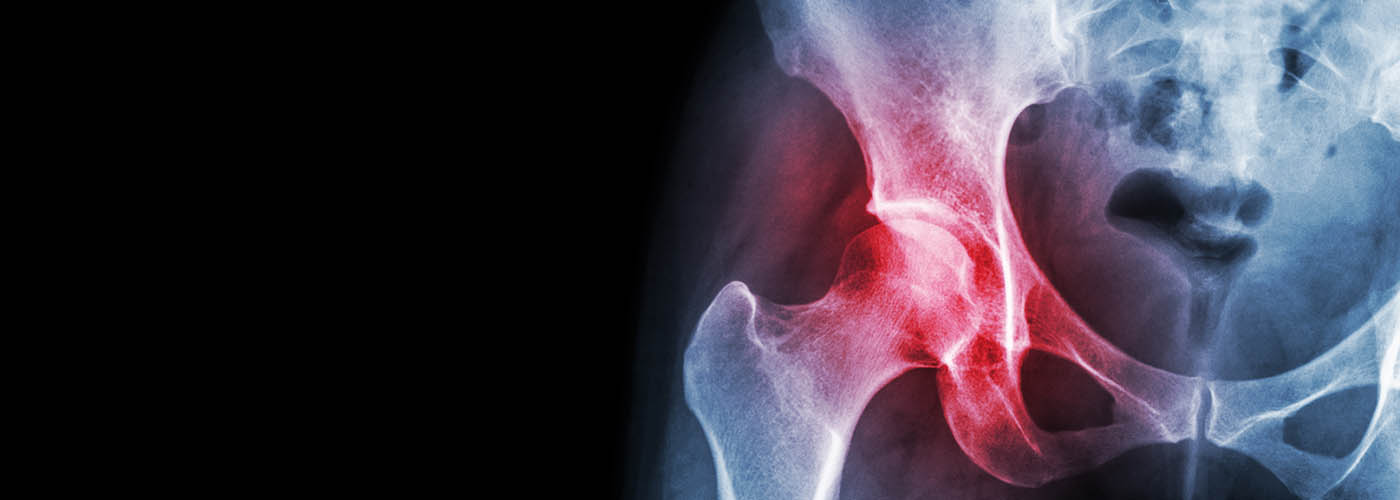 X-ray of a hip showing inflammation in the joint